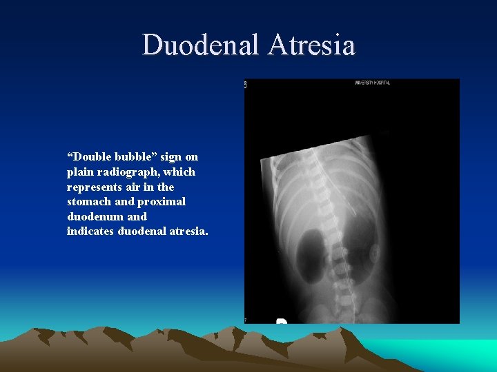 Duodenal Atresia “Double bubble” sign on plain radiograph, which represents air in the stomach