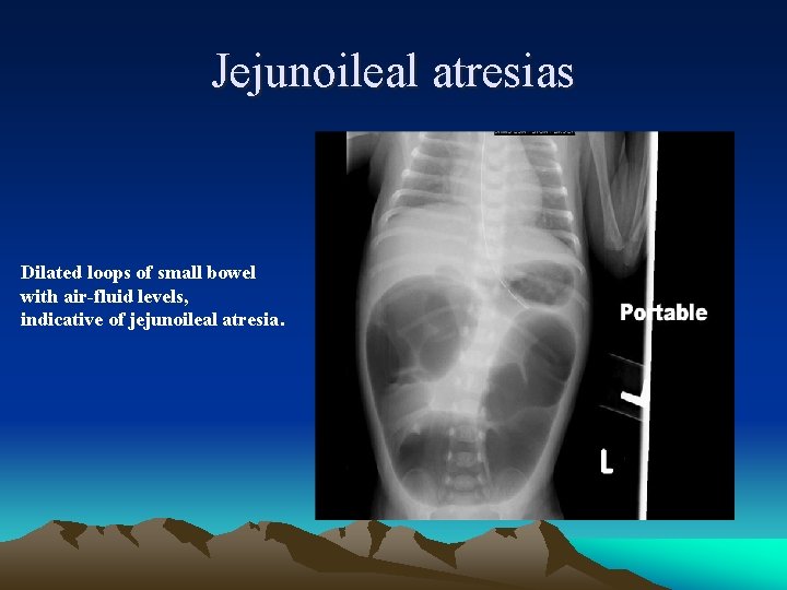 Jejunoileal atresias Dilated loops of small bowel with air-fluid levels, indicative of jejunoileal atresia.