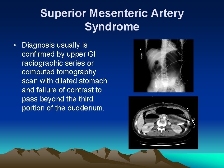 Superior Mesenteric Artery Syndrome • Diagnosis usually is confirmed by upper GI radiographic series
