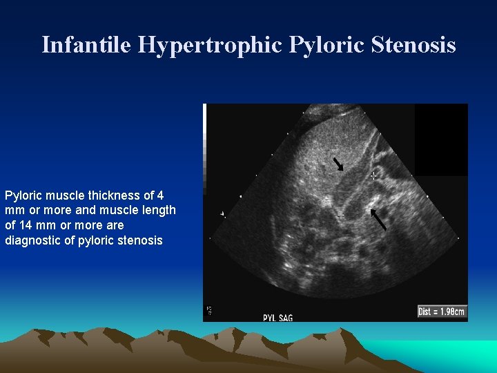 Infantile Hypertrophic Pyloric Stenosis Pyloric muscle thickness of 4 mm or more and muscle