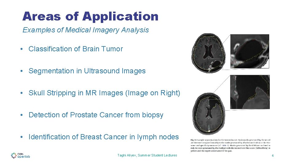 Areas of Application Examples of Medical Imagery Analysis • Classification of Brain Tumor • Areas of Application Examples of Medical Imagery Analysis • Classification of Brain Tumor •