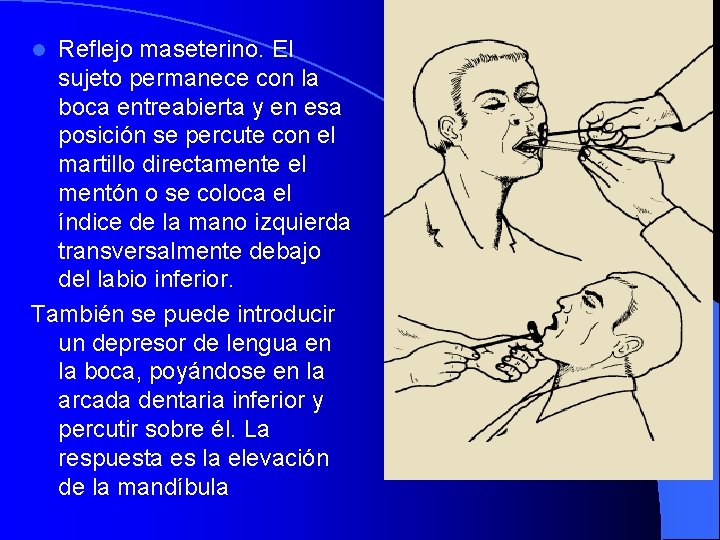 Reflejo maseterino. El sujeto permanece con la boca entreabierta y en esa posición se