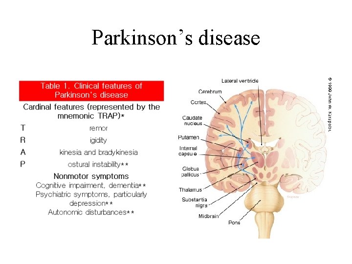 Parkinson’s disease 