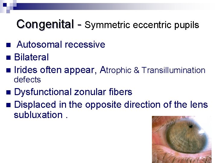  Congenital - Symmetric eccentric pupils Autosomal recessive n Bilateral n Irides often appear,