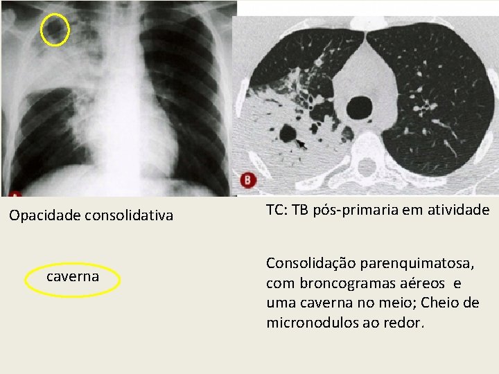 Opacidade consolidativa caverna TC: TB pós-primaria em atividade Consolidação parenquimatosa, com broncogramas aéreos e