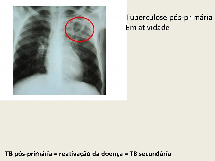 Tuberculose pós-primária Em atividade TB pós-primária = reativação da doença = TB secundária 