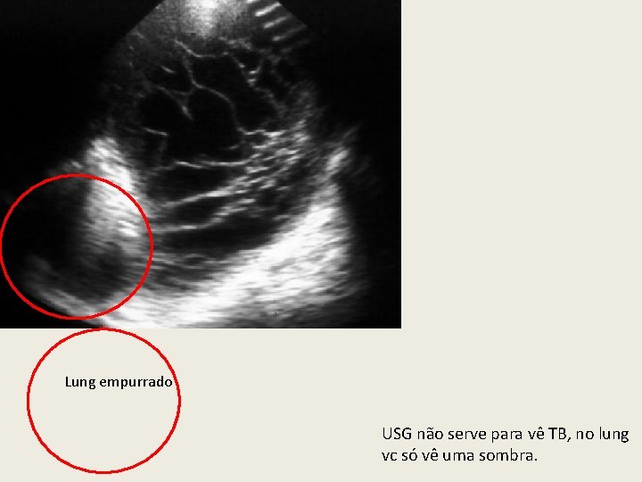 Lung empurrado USG não serve para vê TB, no lung vc só vê uma