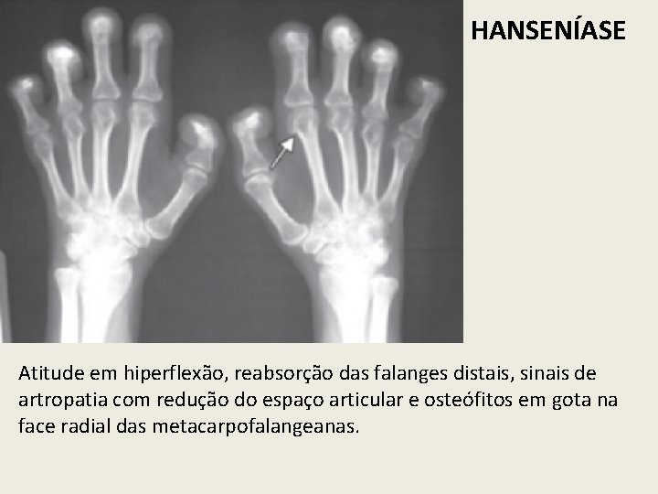 HANSENÍASE Atitude em hiperflexão, reabsorção das falanges distais, sinais de artropatia com redução do