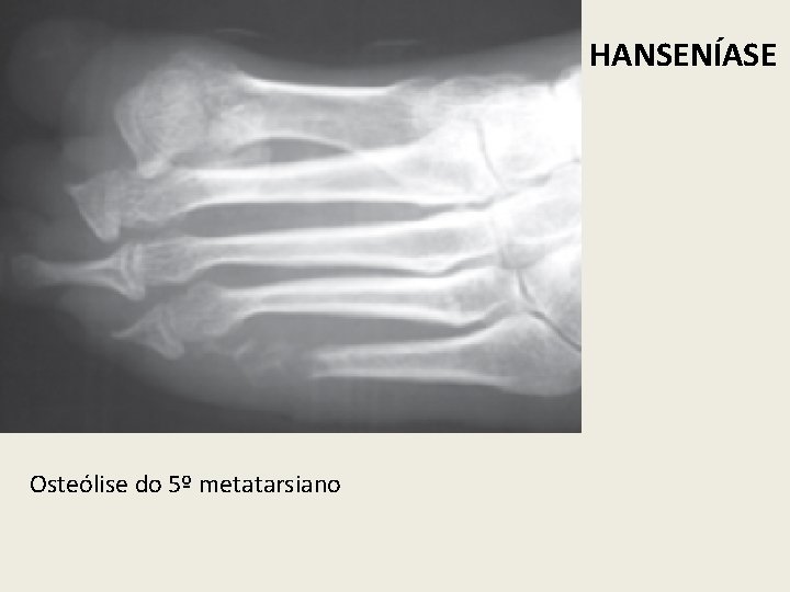 HANSENÍASE Osteólise do 5º metatarsiano 