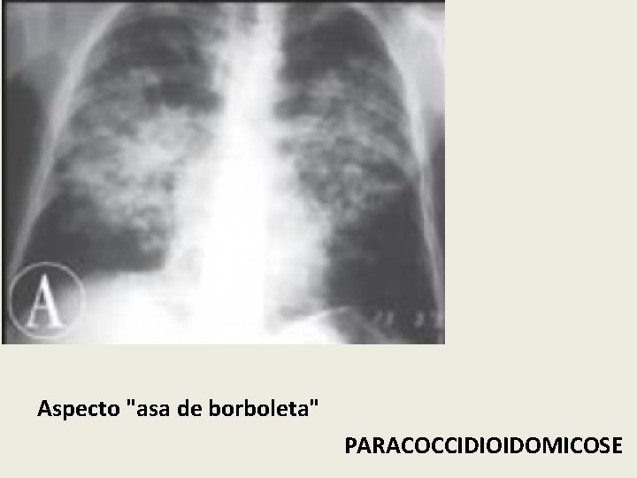 Aspecto "asa de borboleta" PARACOCCIDIOIDOMICOSE 