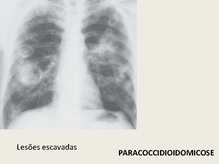 Lesões escavadas PARACOCCIDIOIDOMICOSE 