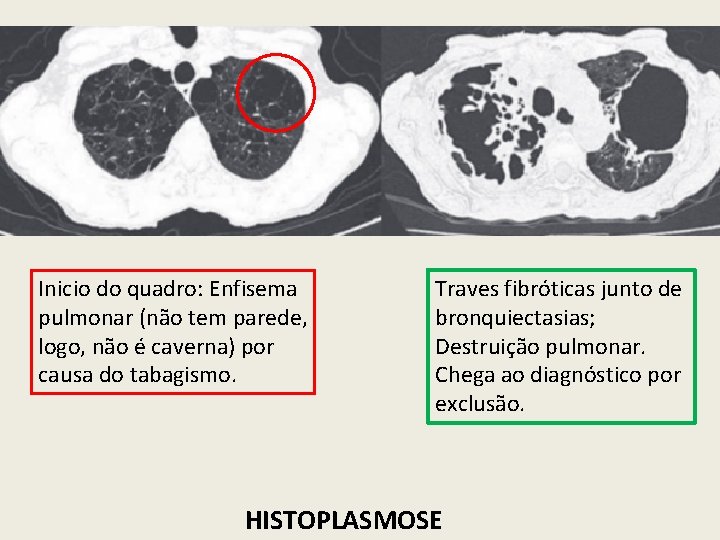 Inicio do quadro: Enfisema pulmonar (não tem parede, logo, não é caverna) por causa