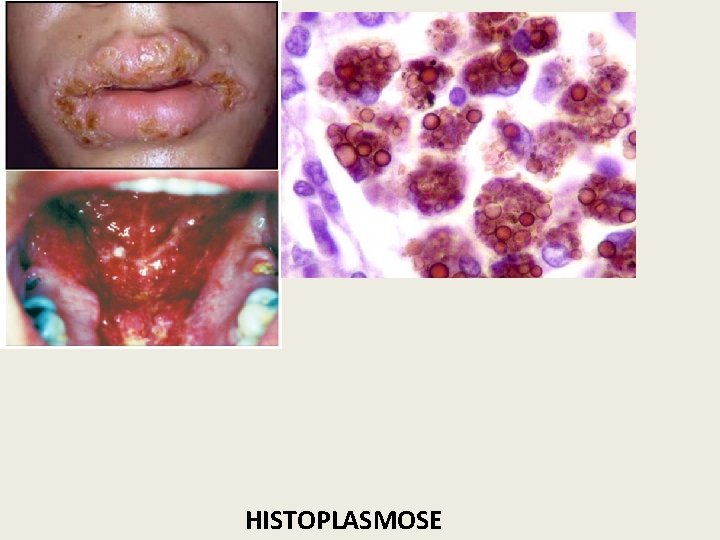 HISTOPLASMOSE 