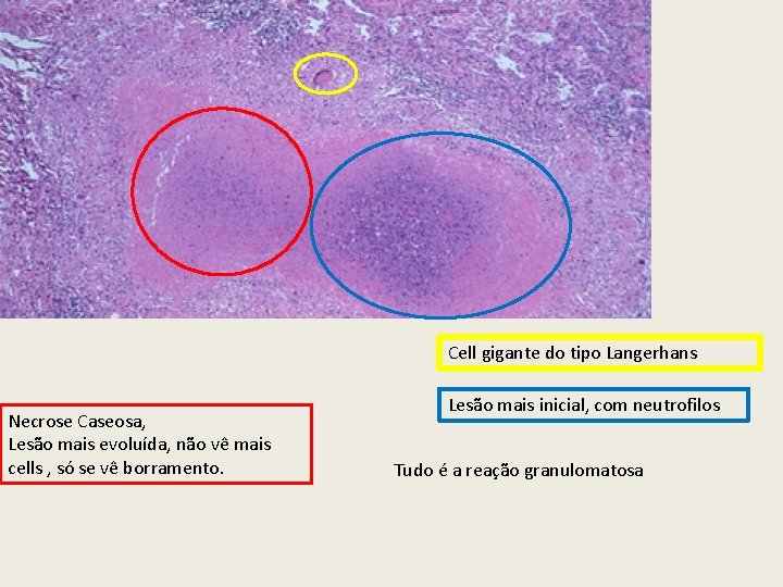 Cell gigante do tipo Langerhans Necrose Caseosa, Lesão mais evoluída, não vê mais cells