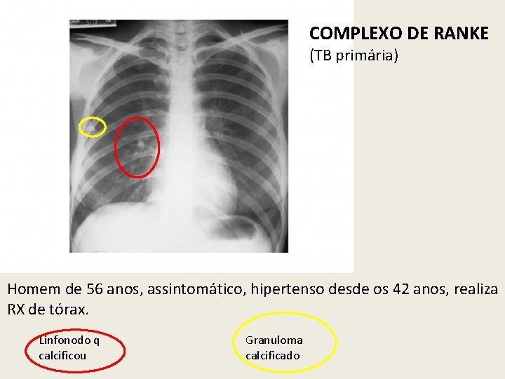 COMPLEXO DE RANKE (TB primária) Homem de 56 anos, assintomático, hipertenso desde os 42