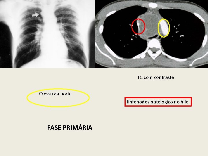 TC com contraste Crossa da aorta linfonodos patológico no hilo FASE PRIMÁRIA 