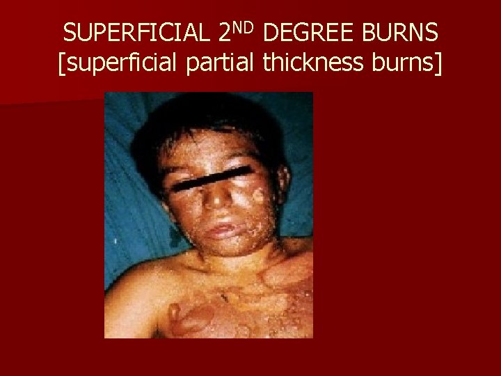 SUPERFICIAL 2 ND DEGREE BURNS [superficial partial thickness burns] 