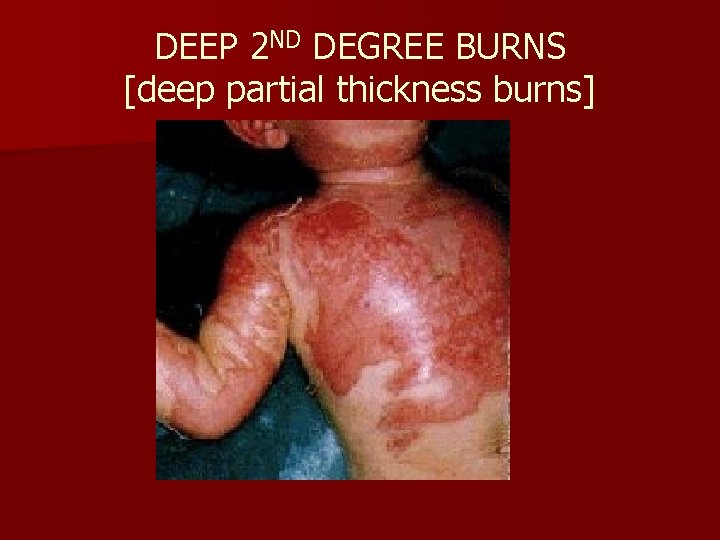 DEEP 2 ND DEGREE BURNS [deep partial thickness burns] 