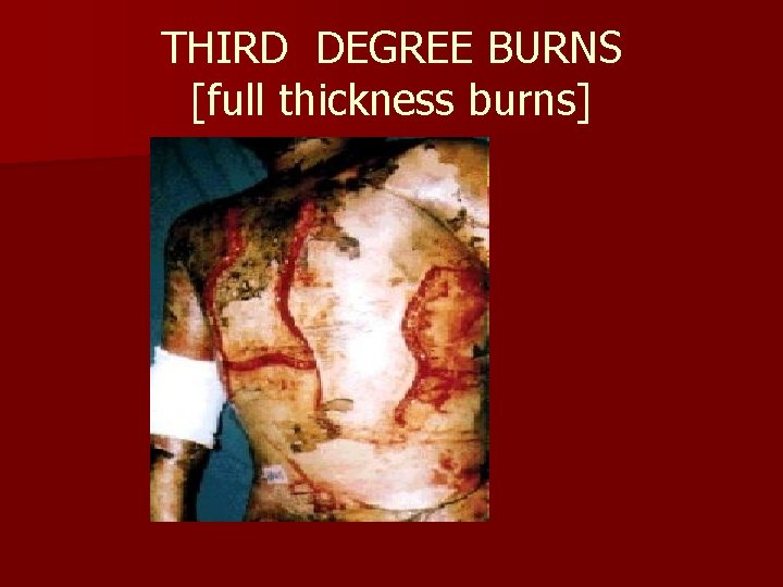 THIRD DEGREE BURNS [full thickness burns] 