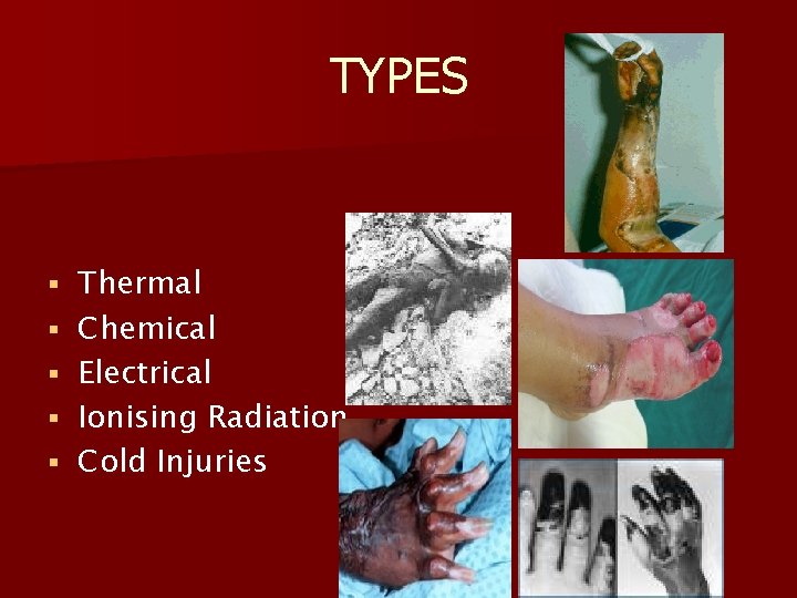 TYPES § § § Thermal Chemical Electrical Ionising Radiation Cold Injuries 