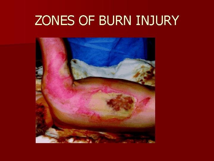 ZONES OF BURN INJURY 