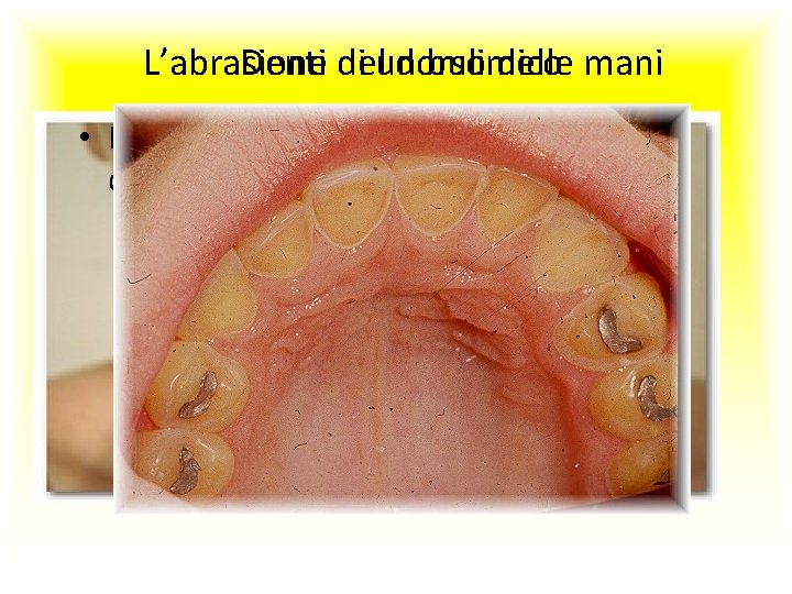 L’abrasione del dorso delle mani Denti di un bulimico • Fare clic per modificare