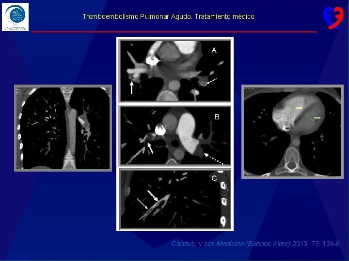 Tromboembolismo Pulmonar Agudo. Tratamiento médico Cáneva. y col. Medicina (Buenos Aires) 2013; 73: 124