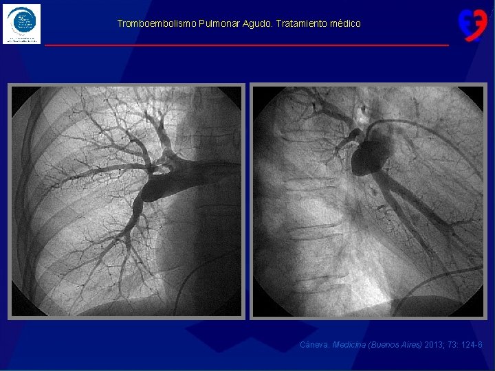 Tromboembolismo Pulmonar Agudo. Tratamiento médico Cáneva. Medicina (Buenos Aires) 2013; 73: 124 -6 