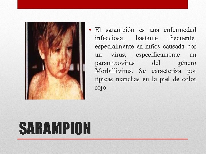  • El sarampión es una enfermedad infecciosa, bastante frecuente, especialmente en niños causada