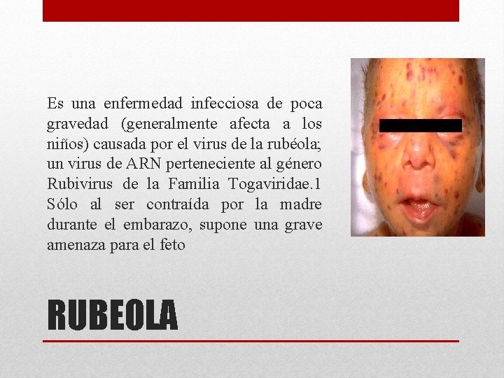 Es una enfermedad infecciosa de poca gravedad (generalmente afecta a los niños) causada por