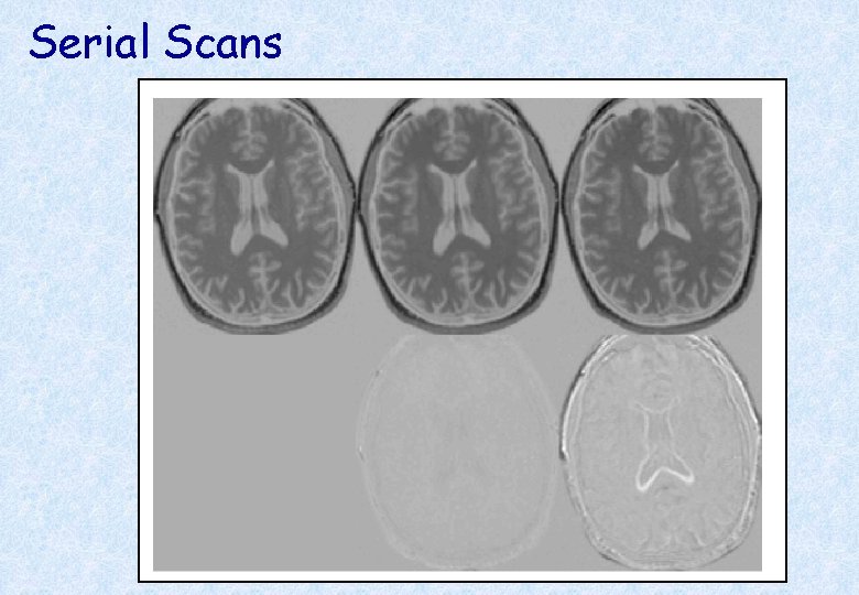 Serial Scans Early Late Difference Data from the Dementia Research Group, Queen Square. 