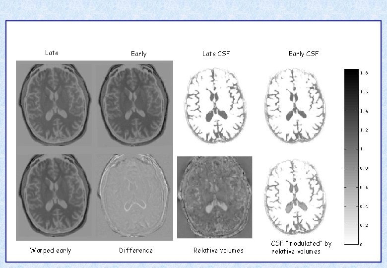 Late Warped early Early Difference Late CSF Relative volumes Early CSF “modulated” by relative