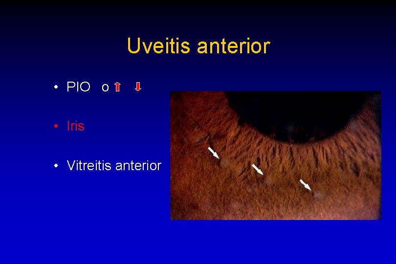 Uveitis anterior • PIO o • Iris • Vitreitis anterior 