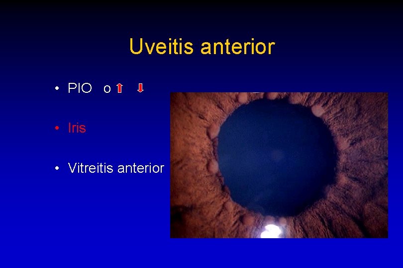 Uveitis anterior • PIO o • Iris • Vitreitis anterior 