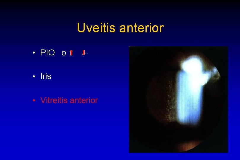 Uveitis anterior • PIO o • Iris • Vitreitis anterior 
