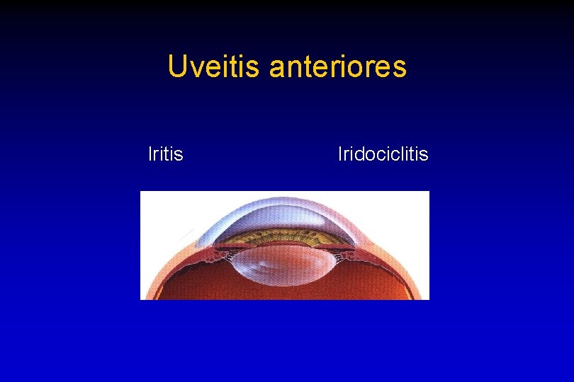 Uveitis anteriores Iritis Iridociclitis 