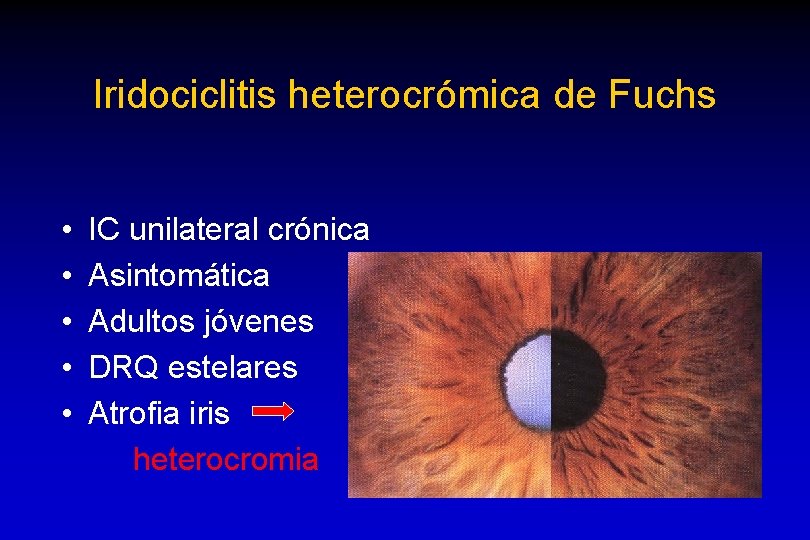 Iridociclitis heterocrómica de Fuchs • • • IC unilateral crónica Asintomática Adultos jóvenes DRQ