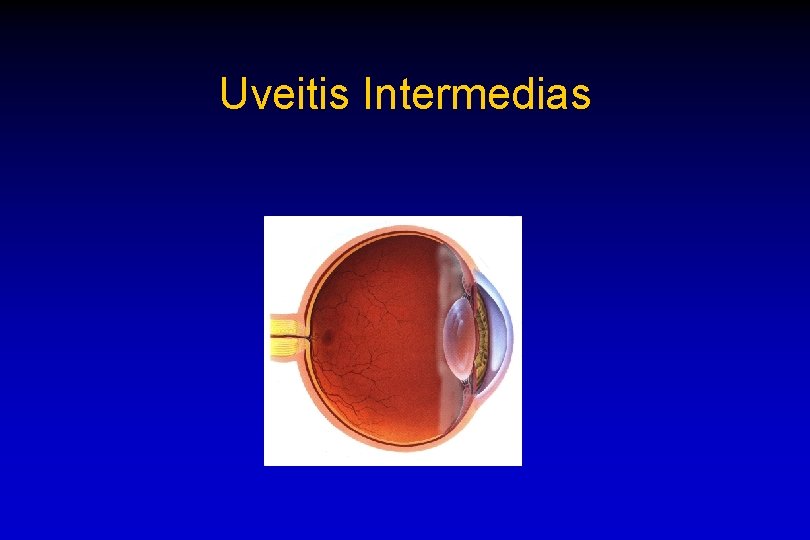 Uveitis Intermedias 