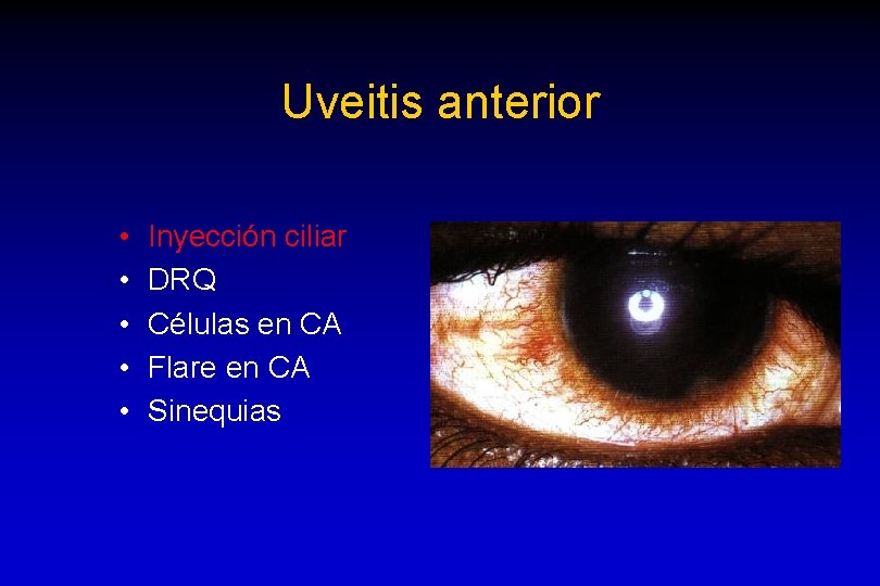 Uveitis anterior • • • Inyección ciliar DRQ Células en CA Flare en CA