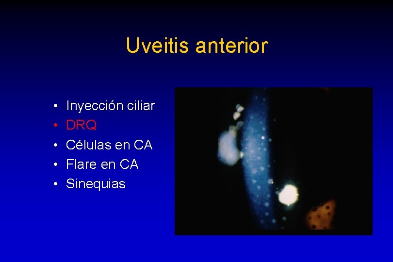 Uveitis anterior • • • Inyección ciliar DRQ Células en CA Flare en CA