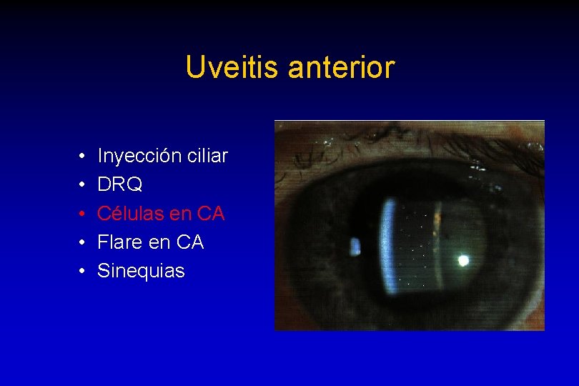 Uveitis anterior • • • Inyección ciliar DRQ Células en CA Flare en CA