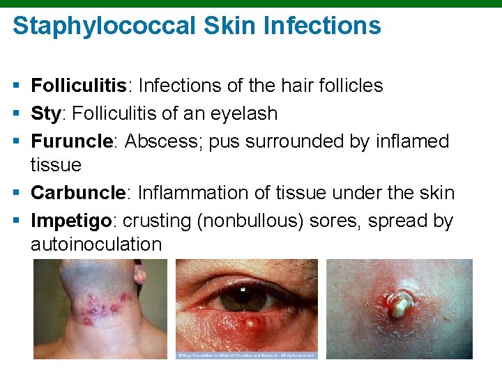 Staphylococcal Skin Infections § Folliculitis: Infections of the hair follicles § Sty: Folliculitis of