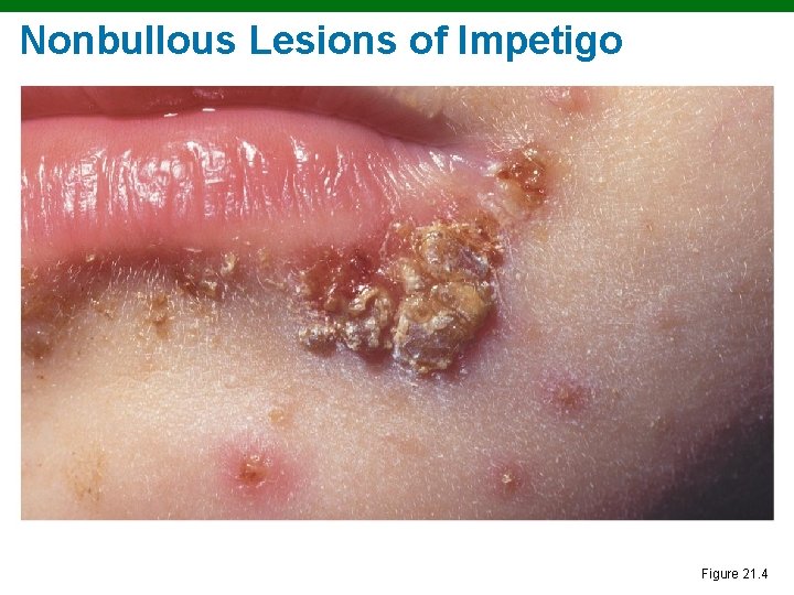 Nonbullous Lesions of Impetigo Figure 21. 4 