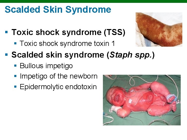 Scalded Skin Syndrome § Toxic shock syndrome (TSS) § Toxic shock syndrome toxin 1