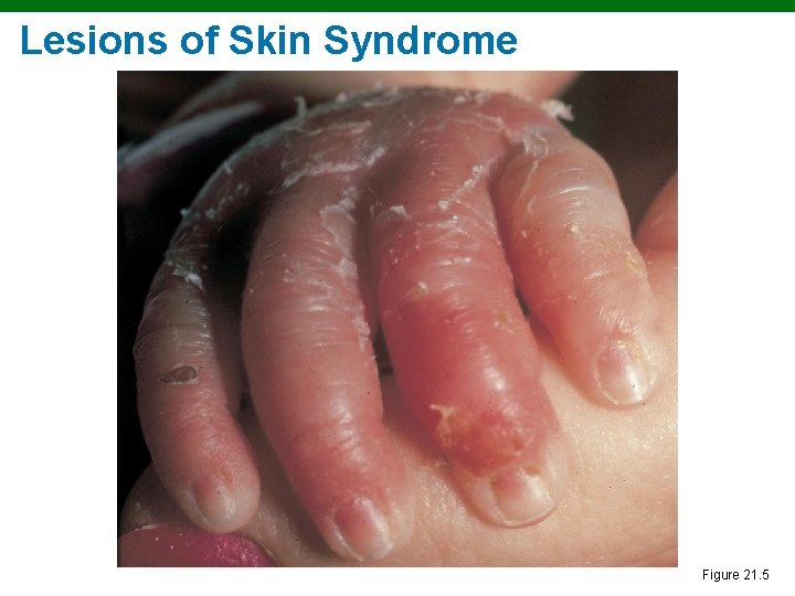 Lesions of Skin Syndrome Figure 21. 5 