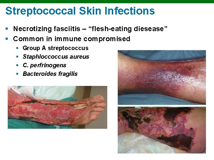 Streptococcal Skin Infections § Necrotizing fasciitis – “flesh-eating diesease” § Common in immune compromised