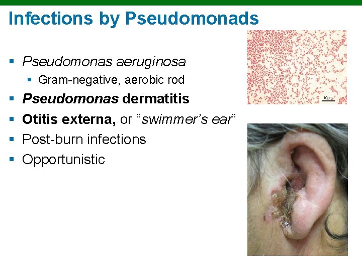 Infections by Pseudomonads § Pseudomonas aeruginosa § Gram-negative, aerobic rod § § Pseudomonas dermatitis