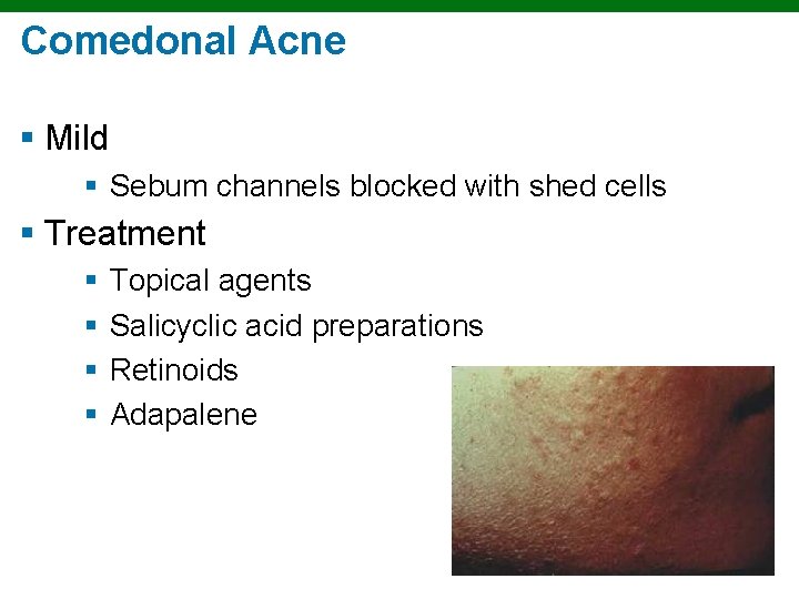 Comedonal Acne § Mild § Sebum channels blocked with shed cells § Treatment §