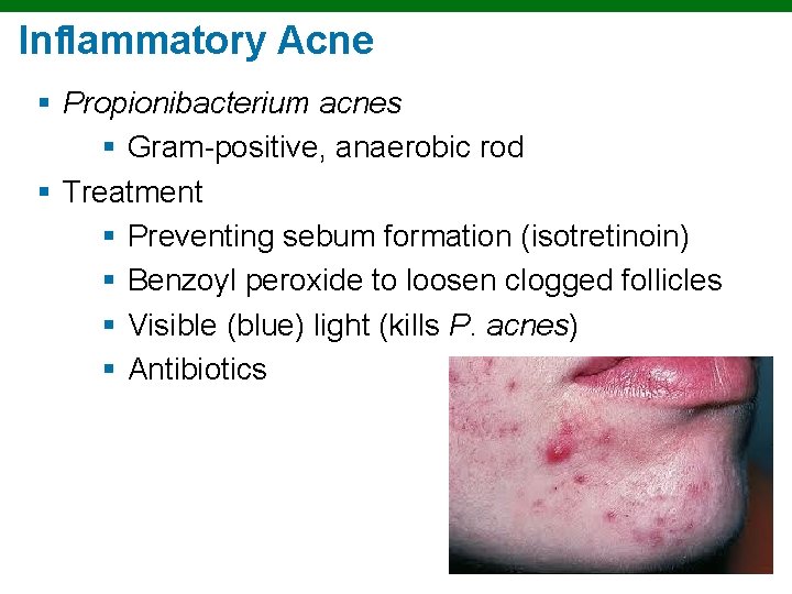 Inflammatory Acne § Propionibacterium acnes § Gram-positive, anaerobic rod § Treatment § Preventing sebum