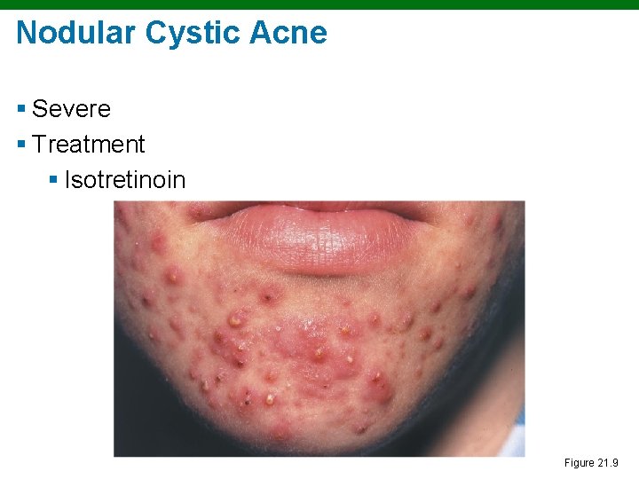 Nodular Cystic Acne § Severe § Treatment § Isotretinoin Figure 21. 9 